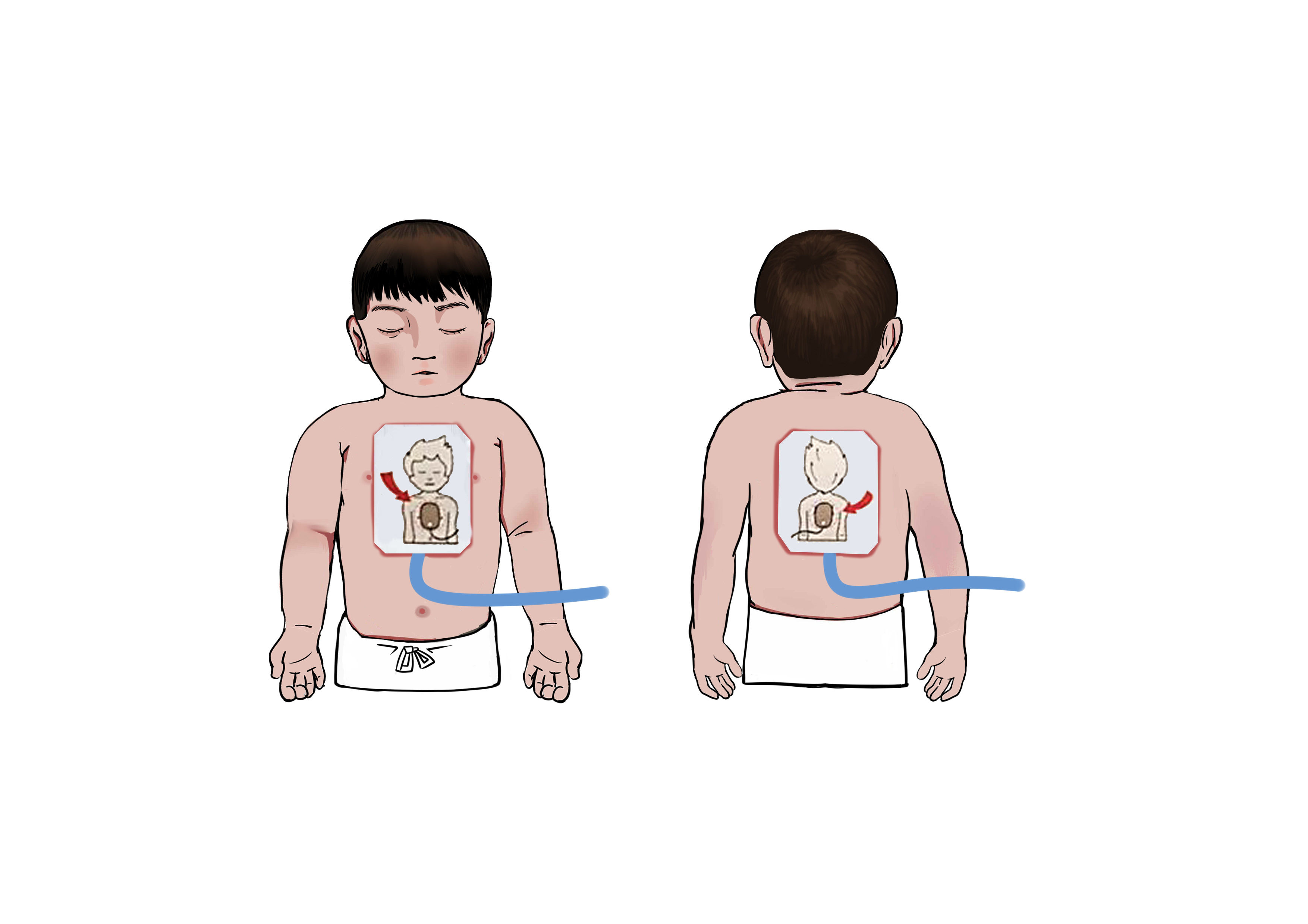 将两片电极片分别贴在婴儿和儿童的胸前正中及背后左肩胛处,体格较大